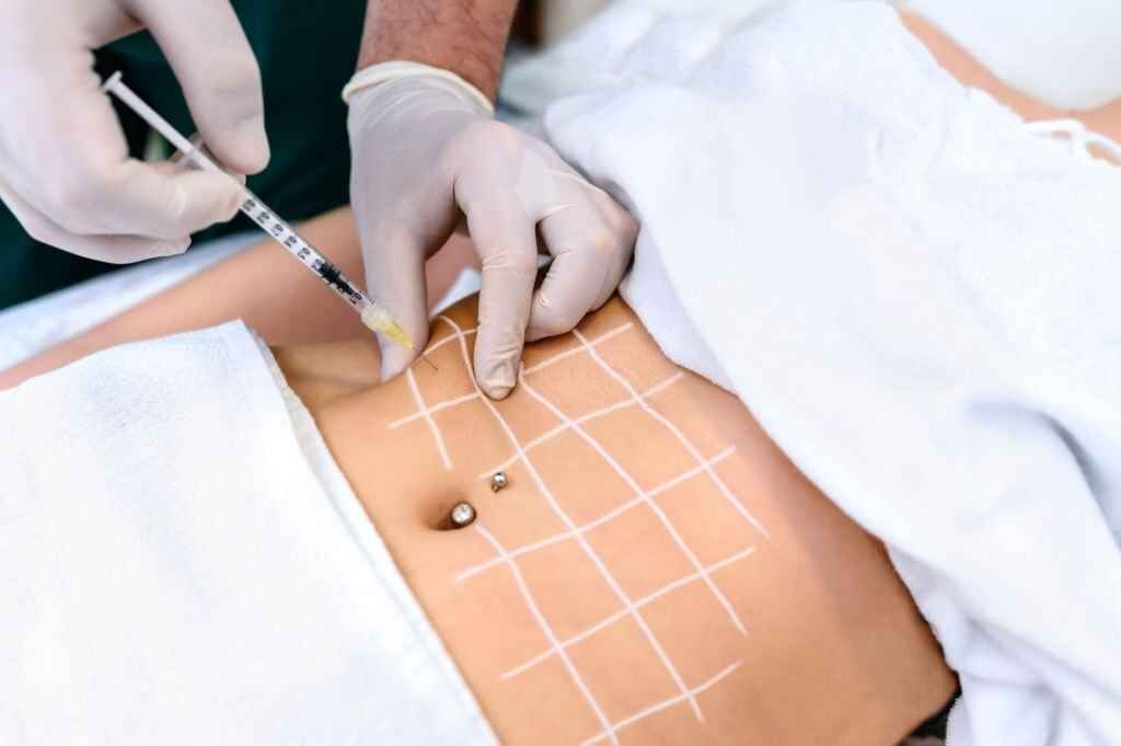 Liposuction
